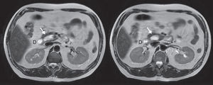 Magnetic resonance cholangiopancreatography showing the diverticulum (arrow) medial to the duodenum (D) in axial views.