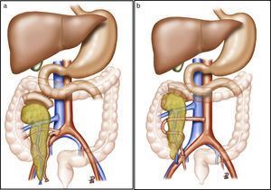 (a) Pancreas transplantation with enteric drainage of the exocrine secretions to the native duodenum, systemic venous drainage and arterial reconstruction of the pancreas using a Y arterial graft; (b) pancreas transplantation with enteric drainage of the exocrine secretions to the native duodenum, systemic venous drainage and arterial reconstruction of the pancreas using end-to-end splenomesenteric anastomosis. The diagram shows the arterial anastomosis of the graft to the aorta. In our series, the anastomosis was done to the right primitive iliac artery.