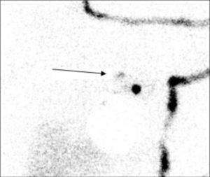 Image of a secondary lymph node on lymphoscintigraphy.