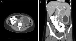 CT scans: (A) axial and (B) coronal.