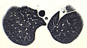 A semisolid lesion is observed in the left upper lobe.
