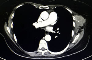 A solid lesion is observed anterior to the tip of the left scapula that is spiculated, poorly outlined and dependent on the musculature of the thoracic wall.