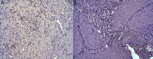 (A) Expression of Ki-67 protein in the esophagus of animals in which the collagen sponge had been used, 8 days after the intervention. Abundant positive fibroblasts are observed (asterisks) and, occasionally, endothelial cells (arrowheads). Immunohistochemistry ABC anti-Ki67×200; (B) expression of the Ki-67 protein in the esophagus of the control animals 8 days after the intervention. No positive cells were observed in the area of inflammatory infiltrate (asterisk). Inmunohistochemistry ABC anti-Ki67×200.