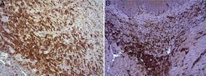 (A) Expression of ECGF in the esophagus of animals in which the collagen sponge was applied 8 days after the intervention. Abundant positive macrophages are observed (asterisks), together with numerous blood vessels (arrowheads). Immunohistochemistry ABC anti-ECGF×200; (B) expression of ECGF in the esophagus of the control animals 8 days after the intervention. A low number of positive cells are observed (arrowheads) in the inflammatory infiltrate, proximal to the area of cellular debris (asterisk). Inmunohistochemistry ABC anti-ECGF×200.