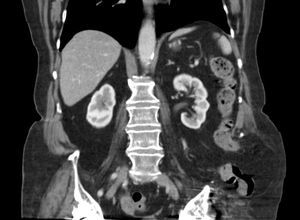 Sagittal abdominal CT scan: portion of extra-abdominal colon, suggesting transiliac hernia.