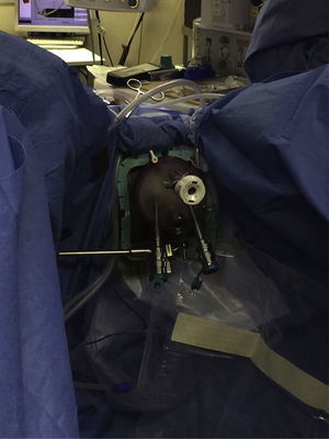 Placement of the transanal access port.