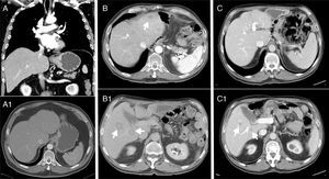 (A-A1) Thickening of the mucosa and submucosa 5cm from the cardia, suspicious lymphadenopathy in the gastrohepatic ligament, with no evidence of distant metastasis; (B-B1) hepatic lesions compatible with metastasis in segments II, VI and VII after 14 months; (C-C1) stable disease with no local recurrence and no growth of the metastases, which are currently smaller than 1cm after 32 months.