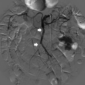 Dissection flap in the first few centimeters of the SMA, causing the closure of multiple ileal branches (white arrows).