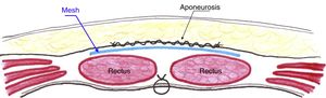 Diagram of the mesh in retrofascial position and on top of the recti muscles, isolated from the subcutaneous space.