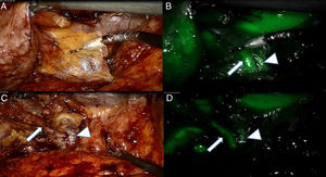 (A) White light imaging of Calot's triangle area after an initial opening of the peri-gallbladder adipose tissue. A tubular structure can be identified. (B) At near-infrared (NIR), a second structure is identified adjacent to the previous one, allowing to identify them as the Cystic Duct (CD; arrow) and the Common Bile Duct (CBD) respectively; see arrow head. (C) White light view after some dissection allowing to dissect the CD. (D) NIR imaging confirms the accurate interpretation of the anatomy.
