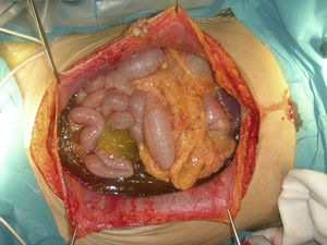 View of the peritoneal cavity after laparotomy in a patient with PMP secondary to rupture of a low-grade mucinous appendiceal neoplasm. Note the presence of mucinous ascites and mucinous implants also in the umbilical area.