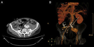 CT angiography images: (A) retroperitoneal bleeding due to rupture of the left iliac pseudoaneurysm; (B) previously placed iliac stents and pseudoaneurysm due to distal leakage.