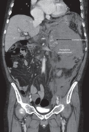 Abdominal CT scan showing evidence of a retroperitoneal hematoma measuring 15×10×17cm, with a leak of contrast material, encompassing the left adrenal gland.