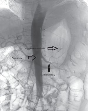 Arteriography demonstrating an arterial plexus with extravasation of contrast related with the active bleeding in the region of the left adrenal artery.