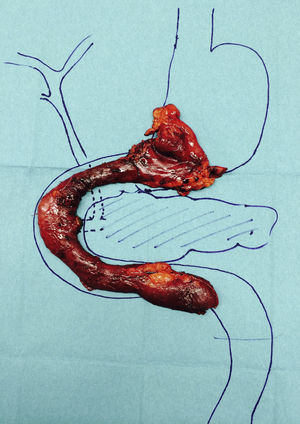 Antroduodenectomy piece with pancreatic preservation.