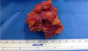 Image of the surgical piece.