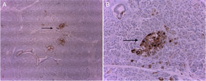 Images of immunohistochemistry with chromogranin: the neuroendocrine cells of the islets of Langerhans are stained brown (right image at higher magnification, 40×).