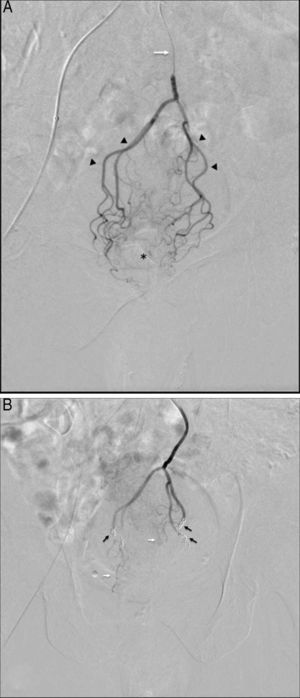 (A) Selective digital subtraction arteriography via microcatheter (white arrow) at the beginning of the superior rectal artery, showing proximal branches (arrowheads) and small distal branches dependent on these arteries (asterisk); (B) post-embolization follow-up: note the absence of overall contrast uptake in the distal rectal territory after the release of the coils (black arrows) and small unobstructed remnant branches (white arrows), which help maintain sufficient blood flow to avoid ischemia.