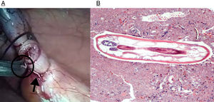 (A) Macroscopic image of the parasites; (B) parasite body at higher magnification. Two receptacles with oocyte corpuscles inside are visible in the left margin (H&E ×40).
