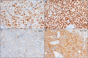 Immunohistochemistry study of the lumpectomy showing intense positivity for receptors of estrogen and progesterone, cytokeratins AE1/AE3 and HER2.