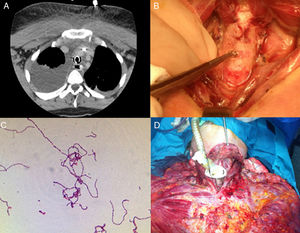 (A) Right pleural effusion with bilateral atelectasis with involvement of the soft tissue of the superior mediastinum; (B) presence of tissue hypoperfusion, edema and involvement of the trachea during the first surgical debridement; (C) microbiological diagnosis of group A Streptococcus; (D) intraoperative findings of extensive involvement of the superior and inferior mediastinum during the last surgical debridement.