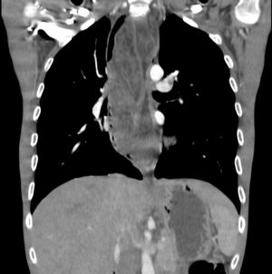 Coronal CT scan: esophageal, heterogeneous tumor occupying the esophageal lumen practically in its entirety that extends from cervical to distal esophagus.