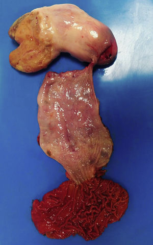 Macroscopic image of opening of surgical piece showing gastric region with folds without alterations and esophagus with pedunculated tumor anchored in its upper region.