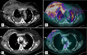 PET/CT chest scan: (A) Multiple bilateral axillary lymphadenopathies, the largest on the right measuring 4cm (arrow), with subcutaneous involvement of both breasts, predominantly right, and ipsilateral pleural effusion; (B) Pathological uptake of 18F-FDG (fludeoxyglucose) in the right breast, left breast, right lower sulcus and bilateral pulmonary parenchyma (millimeter nodules) related with the lymphomatous infiltration; (C) Decrease in the overall size of the right breast with air bubbles in its interior related with necrosis and reduction of axillary lymphadenopathies, the largest right measuring 2.9cm; (D) Morpho-metabolic improvement of the lymph node, pulmonary and subcutaneous cellular tissue involvement, suggestive of a good response to treatment.