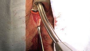 Closure of the fistula orifice prior to the placement of the OTSC® device.