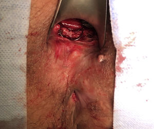 OTSC® clip in place.