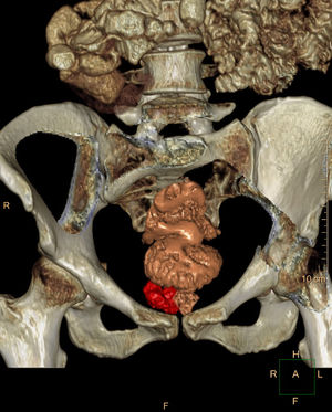 3D computed tomography reconstruction.
