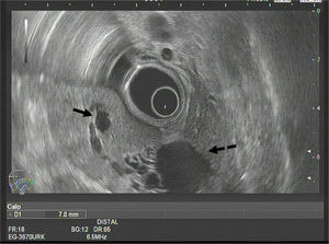 Endoscopic ultrasound image showing normal main bile duct diameter (solid arrow) and dilatation of the left bile duct with intrahepatic cystic lesions (dashed arrow).