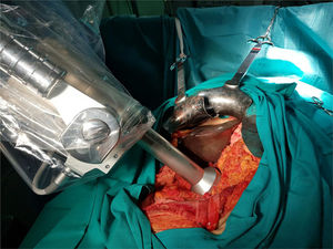 Application of the Intrabeam® device for IORT in cancer of the pancreas.