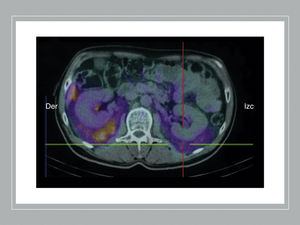 SPECT/CT 123I-MIBG study: there is evidence of diffuse, bilateral and symmetric uptake of the radiocontrast agent in both perirenal spaces, extending toward the iliac crests. In the right adrenal gland, a nodular image measuring approximately 3.5cm is observed, which does not present pathological uptake of the radiotracer, probably related with the myelolipoma.