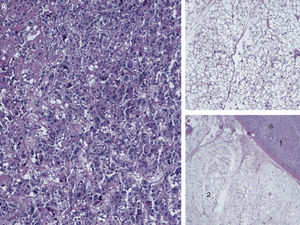 Pathology report: (A) histology sections (20×) with hematoxylin–eosin (HE), compatible with pheochromocytoma; (B) sections (20×) with HE showing multivacuolated brown fat cells with abundant granular cytoplasm and small central nucleus: these findings were consistent with the diagnosis of hibernoma (typical variant); (C) histology sections (10×) with HE showing the contiguity of brown fat tissue (1) and pheochromocytoma (2).