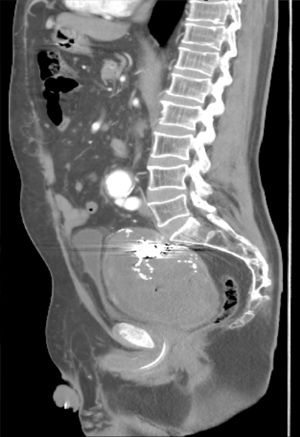 CT: aneurysm of the hypogastric artery compressing the rectum (sagittal view).