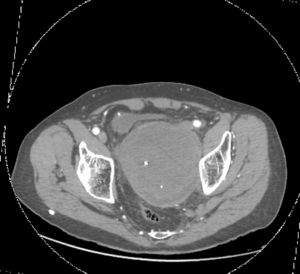 CT: aneurysm of the hypogastric artery compressing the rectum (axial view).