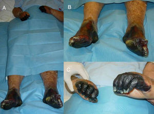 (A) Image of the patient during the acute episode of acral ischemia of both upper and lower extremities; (B) detailed image of the ischemia of the lower limbs; (C) detailed image of the ischemia of the upper limbs.