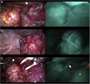 Three cases (A, B and C) of anterior laparoscopic adrenalectomy with Karl Storz® Image 1 HD device. In the left column, the adrenal glands are illuminated with white light and in the right column under NIR light after infusion of 5mg of intravenous ICG. Adrenal hyperfluorescence was observed in all 3 cases, clearly greater than in the surrounding fatty tissue. The white arrow indicates the right suprarenal vein. Hepatic hyperfluorescence is marked with *. The inferior vena cava is marked with an X.