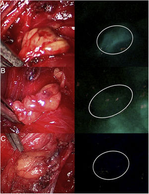 Three parathyroid glands (A, B and C) visualized under white light (left column) and under NIR light (right column) with the Image 1 HD device by Karl Storz®, after infusion of 5mg of intravenous ICG. Parathyroid gland A presents homogeneous hyperfluorescence. The gland marked B shows a patchy or heterogeneous fluorescence due to probable insufficient vascularization. Parathyroid C does not show fluorescence, so its vascularization and function are clearly anticipated to be altered.