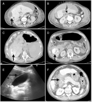 (A) Post-chemoembolization hepatic abscess; (B) subcapsular peri-hepatic collection that continues with the peripheral lesion of segment 6; (C) hemoperitoneum occupying predominantly the right flank; (D) foci of lipiodol extravasation toward the abdominal cavity; (E) abdominal ultrasound with signs of acute cholecystitis; (F) extensive necrosis of the head of the pancreas associated with necrosis of the peripancreatic fat and the root of the mesentery.