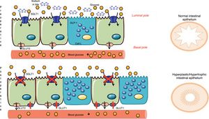 Mechanisms of intestinal adaptation after bariatric surgery. Diversion surgeries (those that separate bile from food) have a malabsorptive component associated with the sodium-glucose transporter in the apical membrane of the enterocyte (SGLT1), which decreases the capacity for glucose absorption from food (Baud, 2016). To compensate for this phenomenon, the intestine becomes hyperplastic and hypertrophic. However, this process is not enough, and therefore the enterocyte awakens a passive transporter from the embryonic stage, called GLUT1, which is expressed in the basolateral membrane (Saeidi51 and Cavin52). This GLUT1 transporter captures the glucose in the blood to provide energy to the new cells and the glycemia therefore drops. Adapted from Cavin et al.52 through Servier Medical Art by Creative Commons Attribution 3.0.