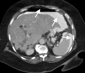 Abdominal computed tomography showing pneumoperitoneum and free peritoneal fluid with evidence of leaked contrast medium (arrows). Given these findings, the patient underwent emergency laparoscopy.