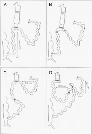 (A) Creation of a 60cm3 gastric pouch with a linear stapler; (B) inverted Y resection of the gastric remnant and ileum, including the anastomosis with the leak; (C) creation of mechanical ileo-ileal and gastrojejunal anastomoses, with a biliopancreatic loop measuring 80cm in length; (D) creation of a 150cm intestinal loop and finally division of the communication between the biliopancreatic loop with the gastrojejunal anastomosis.