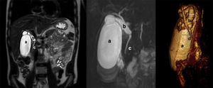Magnetic resonance cholangiopancreatography revealing the cystic duct cyst and its relationship with the gallbladder and the main bile duct: (a) gallbladder; (b) cyst of the cystic duct; (c) main bile duct.