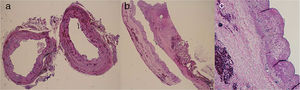 Microscope image of the cyst in the cystic duct: (a) cross section; (b) longitudinal; (c) enlargement of the longitudinal section showing the flattened biliary epithelium with benign features.