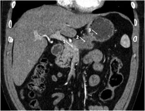 Radiological image showing the vascular infiltration: (1) splenoportal confluence; (2) pancreatic tumor; (3) gastric antrum.