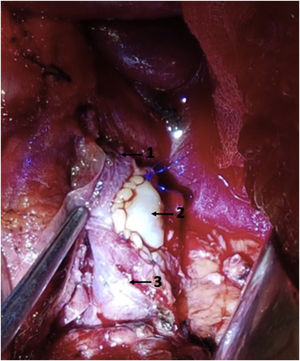 Vascular reconstruction with a lateral autologous graft of the falciform ligament: (1) portal vein; (2) lateral plasty of the falciform ligament; (3) superior mesenteric vein.