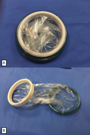 (A) Alexis® retractor device, size XS (4cm in diameter), comprised of 2 flexible rings joined by a polymer membrane; (B) Alexis® retractor device, unrolled before placement.
