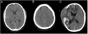 CT scans of patient with traumatic brain injury (TBI): subarachnoid hemorrhage (A) and subdural hematoma (B) requiring decompression surgery. Afterwards, intraparenchymal hemorrhage led to death (C).